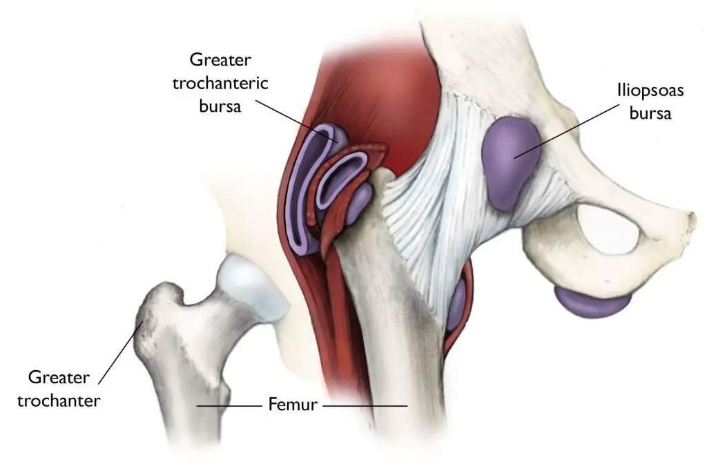 Picture of hip bursitis