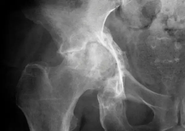 hip arthritis in an X-ray