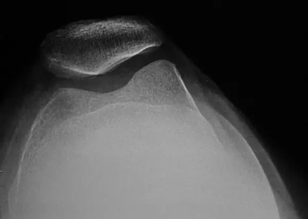 X-ray of patella tracking