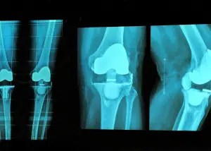 failed knee replacement implant