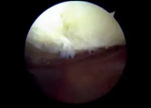 Chondromalacia knee scope