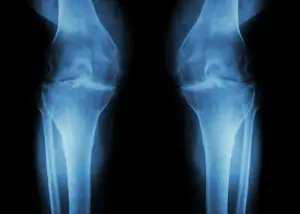 knee arthritis