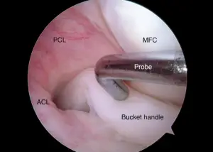 meniscus tear