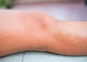 allergic reaction on the leg