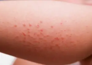 heat rash on skin