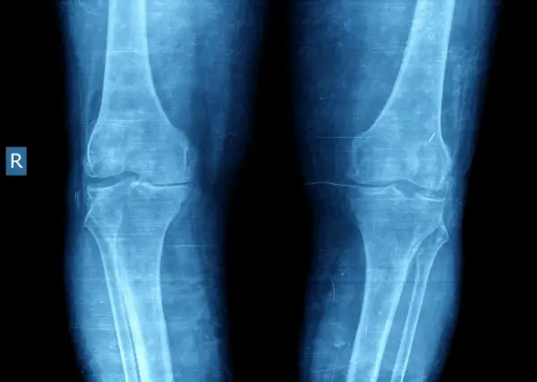 knee xray with medial knee arthritis