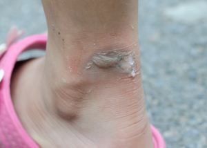 blister on back of ankle