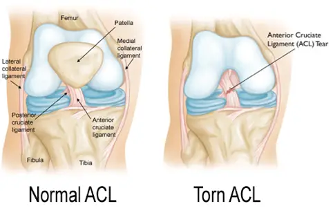 torn ACL