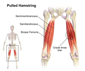 Hamstring Strain