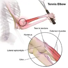 image of tennis elbow and lateral epicondylitis
