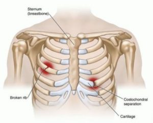 Rib Fracture