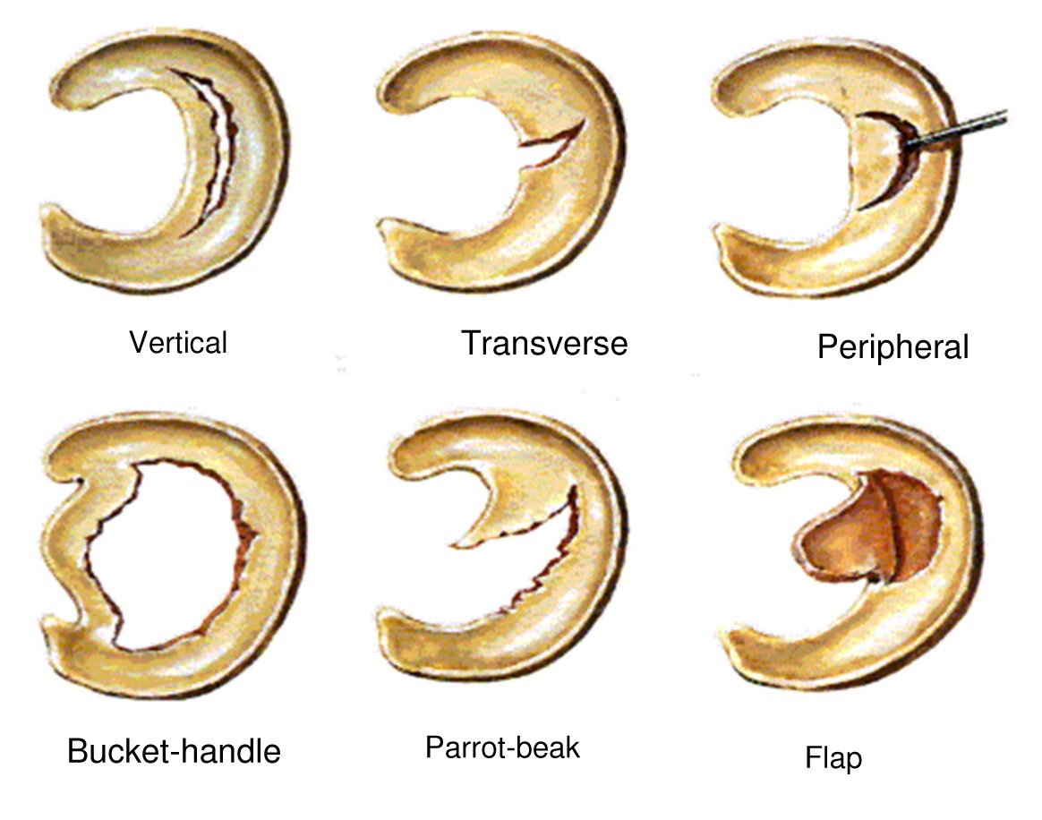 The Best Exercises After Meniscus Surgery - Best Physical Therapy 