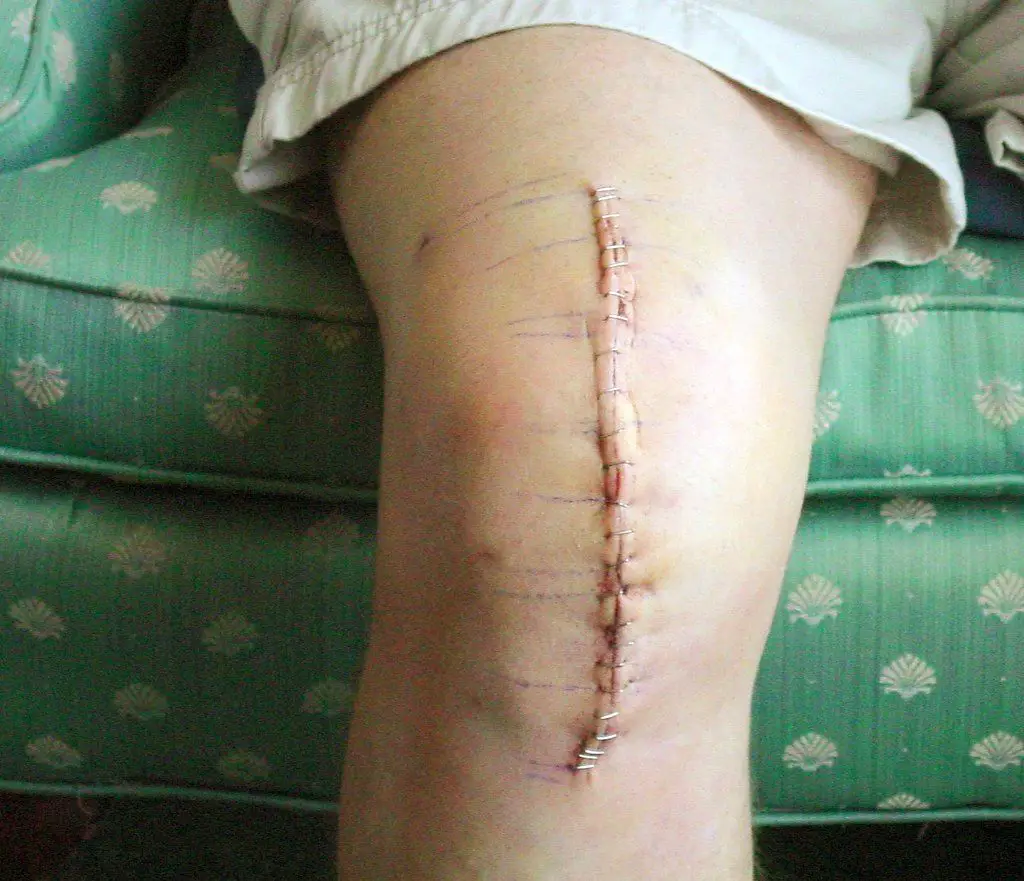 total knee replacement scar