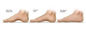 comparison of high arches in the feet