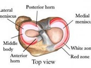zones of healing for a meniscus tear