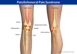 Patellofemoral Pain Syndrome picture