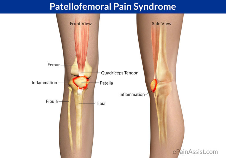 The 5 Best Insoles For Anterior Knee Pain And Patellar Dysfunction 