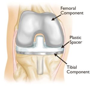 total knee replacement components