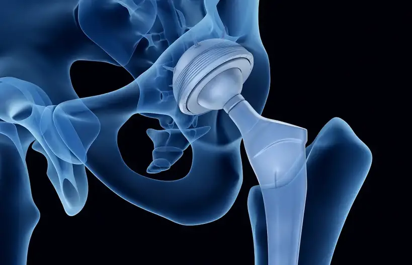 Exercises To Avoid After A Total Hip Replacement To Keep Your Hip Safe