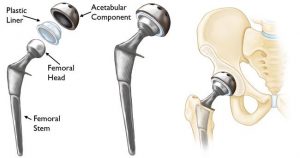 components of a total hip replacement