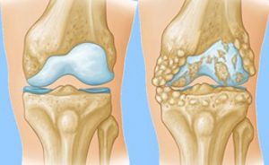 knee arthritis