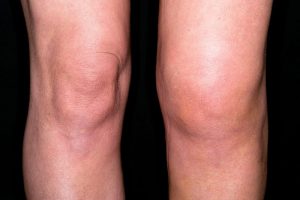 excessive knee swelling