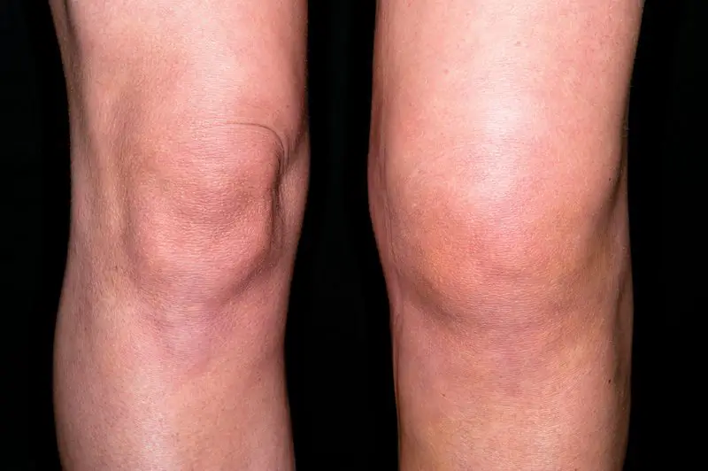 Red Swollen Knees After Exercise at Marvin Irizarry blog