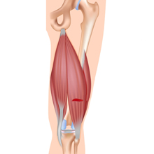 hamstring strain