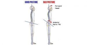 anterior pelvic tilt from tight hip flexors