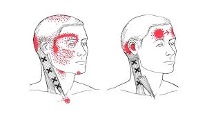 Cervicogenic headaches