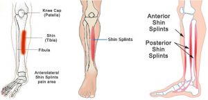 Shin splits anatomy