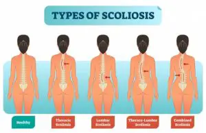 the different types of scoliosis