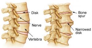 Cervical Spine Arthritis