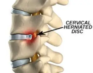 Cervical Spine disc injury