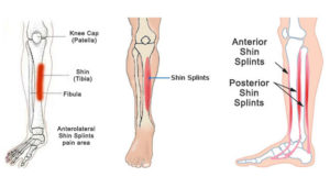 shin splints