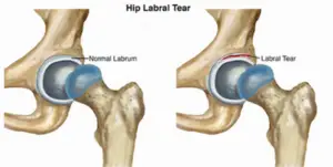 Hip Labral Tear