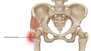 Hip Bursitis