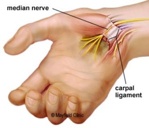 Carpal Tunnel