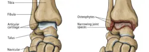 Ankle Arthritis