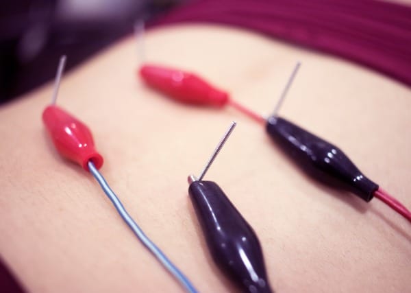 dry needling with TENS