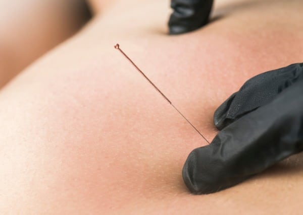 Dry Needling