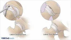 Labral Repair picture