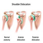 Shoulder Dislocation - A Helpful Recovery Guide - Best Physical Therapy ...