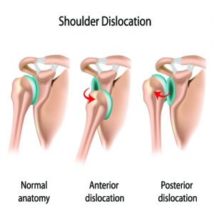 An Image of a Shoulder Dislocation