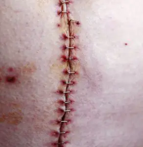 Surgical Scar