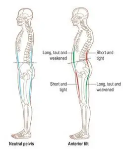 anterior pelvic tilt can lead to hamstring tightness