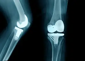 Total Knee Replacement Alignment