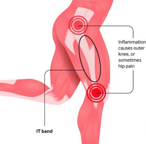 It band Syndrome pain location