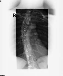 Spine X-ray