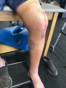 Rash on a leg 2 weeks after a knee replacement